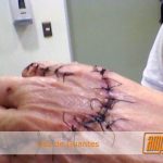 Secuelas por no usar guantes
