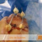 Secuelas por no usar guantes