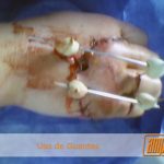 Secuelas por no usar guantes